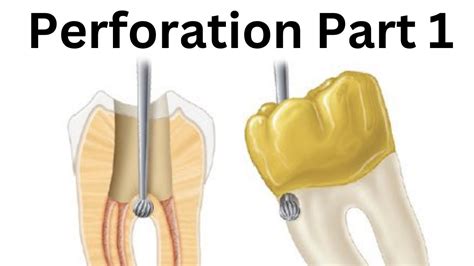 perforation tagalog definition|PERFORATION .